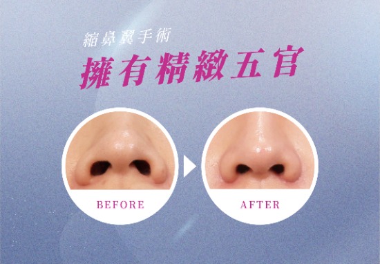 縮鼻翼手術